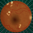 As AI Eye Exams Prove Their Worth